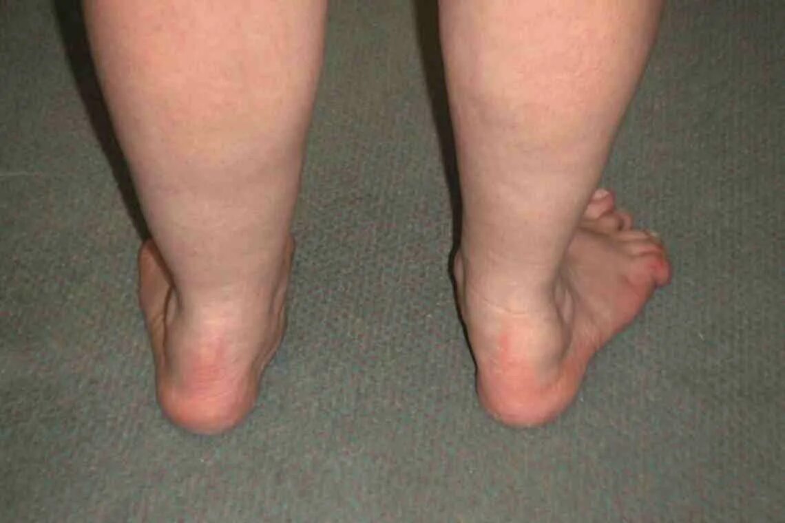 Плоскостно вальгусная деформация стопы. Плосковальгусные стопы у детей мкб. Плоско вальгус стопа мкб 10. Степени плосковальгусной деформации стопы. Плосковальгусные стопы у детей мкб.