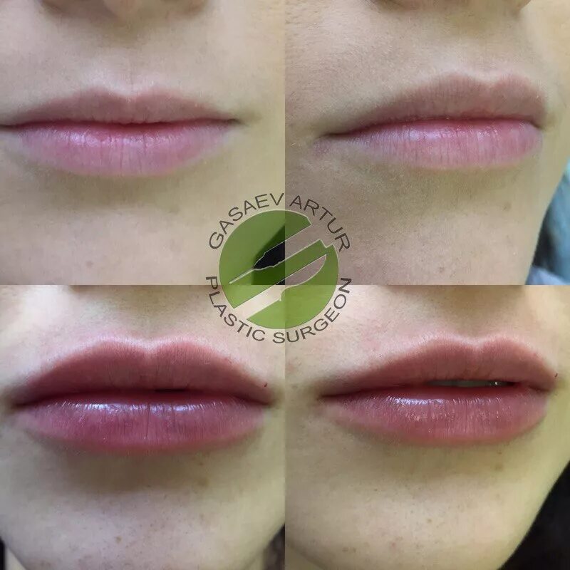 Красивое увеличение губ skin expert. Красивое увеличение губ skin expert