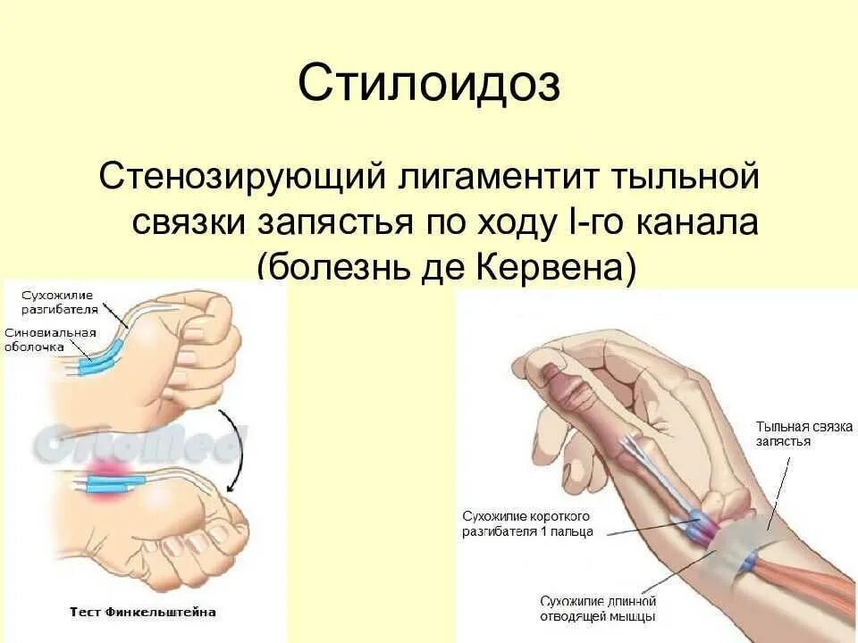 Как лечить сухожилия на пальцах