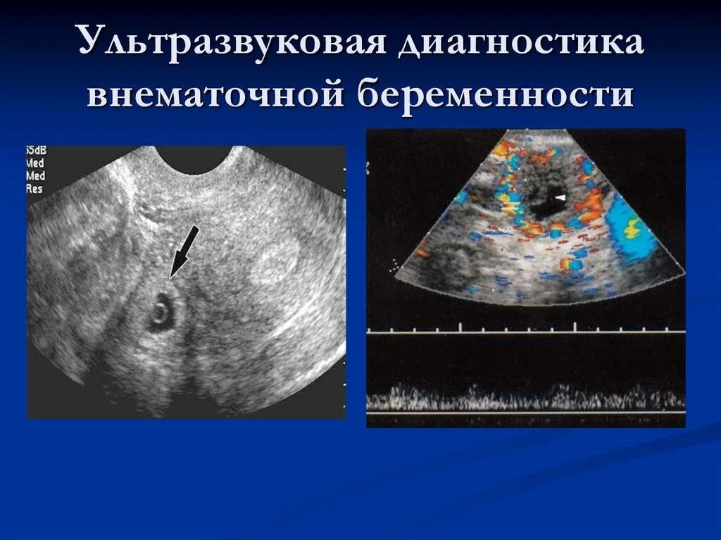 Как отличить маточное. Внематочная Трубная беременность УЗИ. УЗИ признаки трубной беременности. Внематочнаябкременность УЗИ. Внематочная беременность на УЗИ.