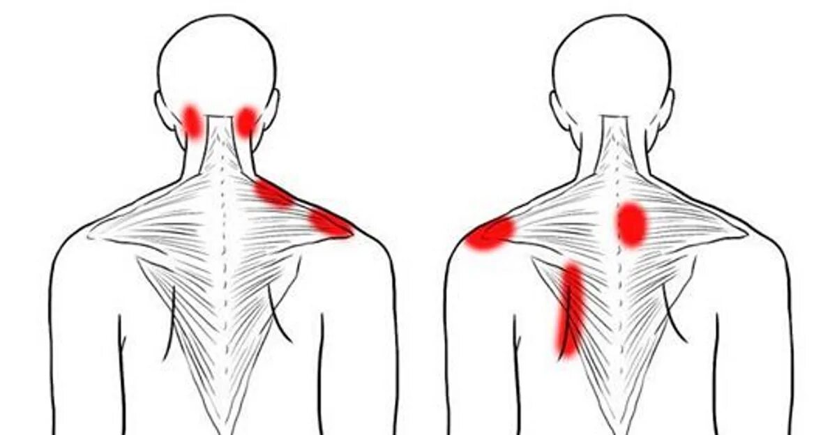 Больно поворачивать голову. Триггерные точки трапециевидной мышцы. Трапециевидная мышца спины триггерные точки. Шейно воротниковая зона схема. Триггерные точки шеи и плеча.