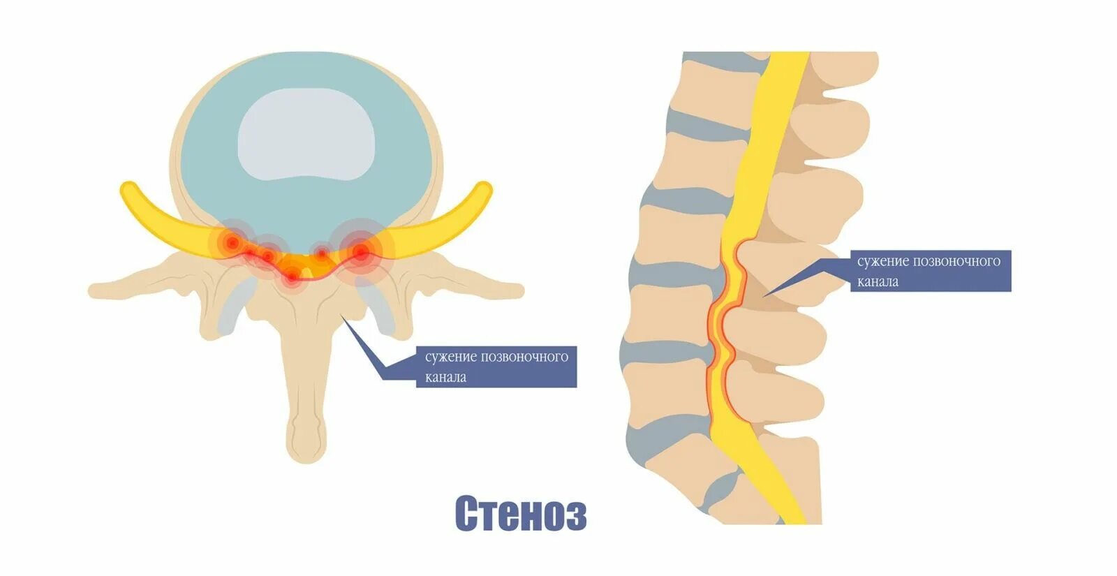 Поясничный абсолютный стеноз. Узость костного позвоночного канала. Стеноз позвоночного канала л3 л5. Сужение позвоночного канала. Стеноз позвоночного канала поясничного отдела.