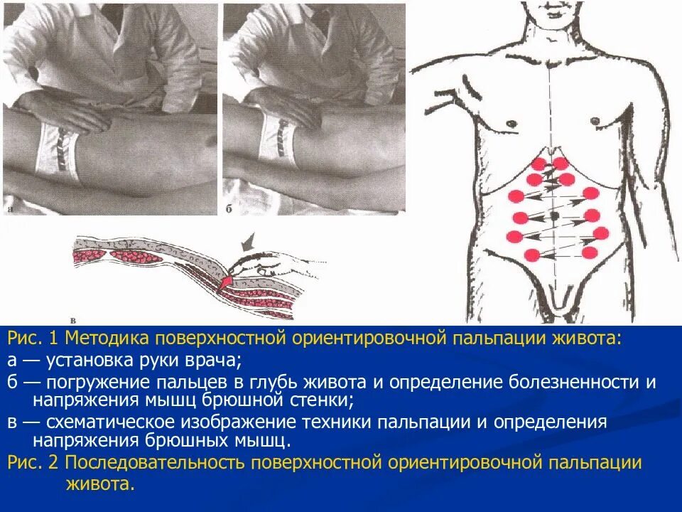 Пальпация живота. Поверхностная пальпация живота пропедевтика. Пальпация брюшной полости пропедевтика. Ориентировочная пальпация живота методика. Последовательность поверхностной пальпации живота.