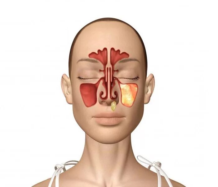 Болезнь когда заложен нос