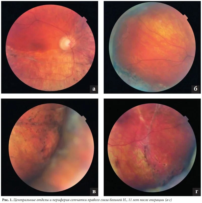 Пузыревидная отслойка сетчатки. Диатермокоагуляция отслойка сетчатки. Тракционно-регматогенная отслойка сетчатки. Отслойка сетчатки глазное дно.