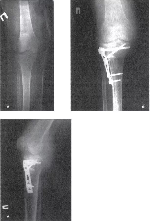 Остеосинтез мыщелков. Осколочный перелом большеберцовой кости. Оскольчатый перелом большеберцовой кости. Краевой перелом большеберцовой кости. Перелом диафиза большеберцовой кости рентген.