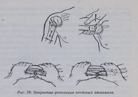 Репозиция перелома детям