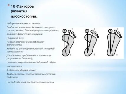 Почему появляется плоскостопие москва