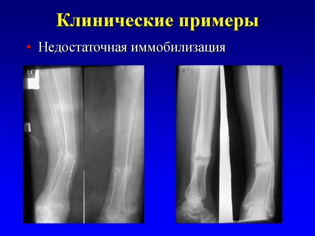 Осложнения при открытых переломах. Ложный сустав презентация. Комбинированные переломы. Осложнения повреждения костей и суставов.