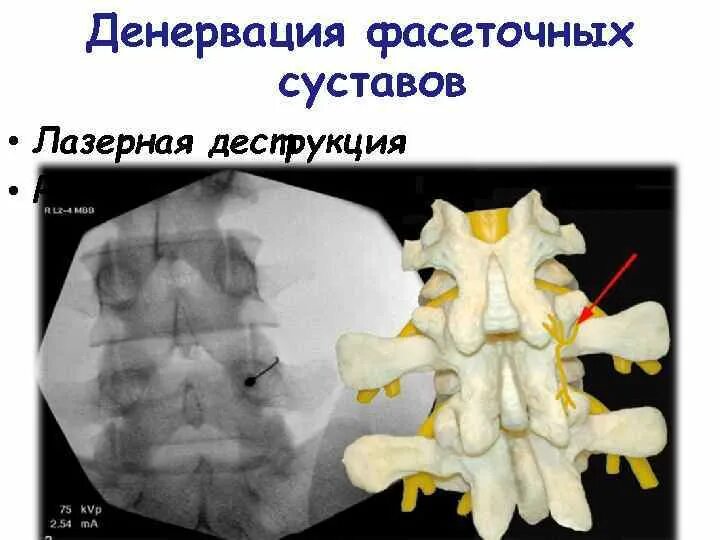 Блокада фасеточных суставов поясничного отдела. Фасеточный синдром блокада. операция радиочастотная денервация фасеточных суставов. фасеточный синдром поясничного отдела.
