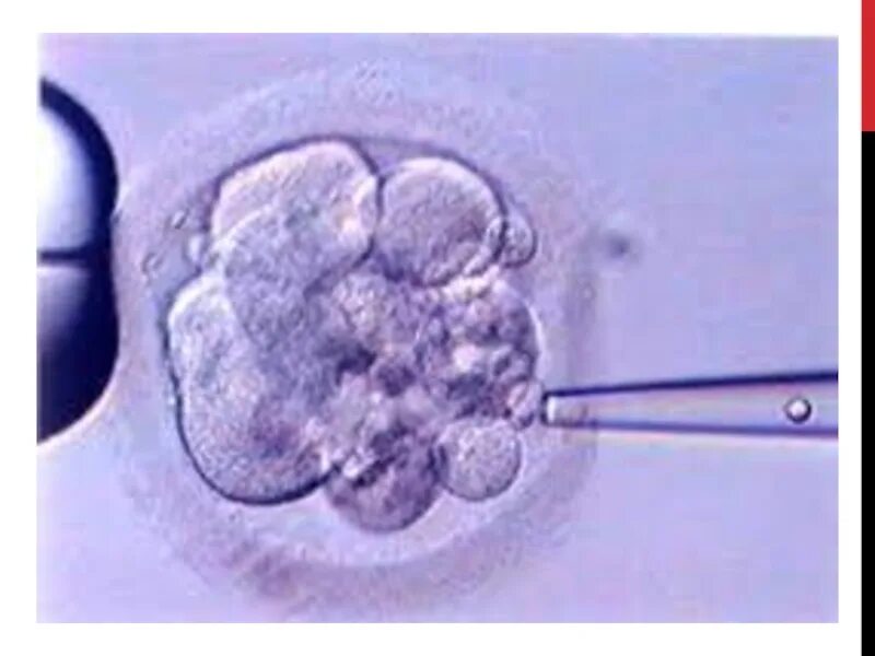 Подсаживали 2 эмбриона. Эко экстракорпоральное оплодотворение.