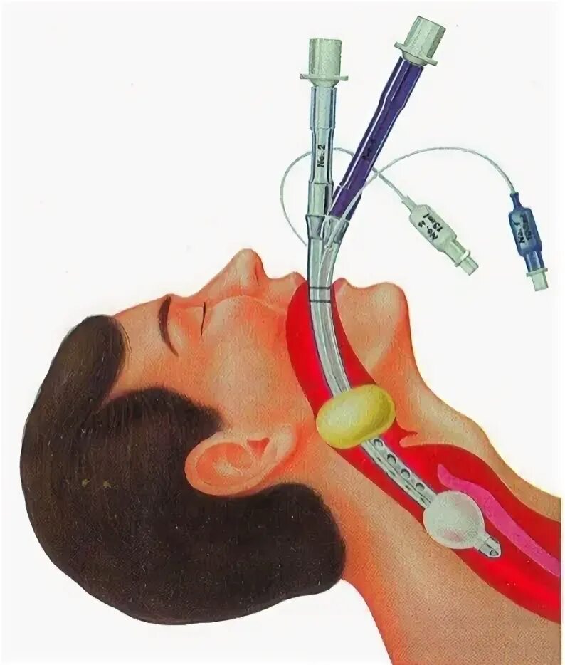 Трубка при наркозе. Ларингеальная маска комбитьюб. Интубационная трубка ИВЛ. Эндобронхиальная интубация.