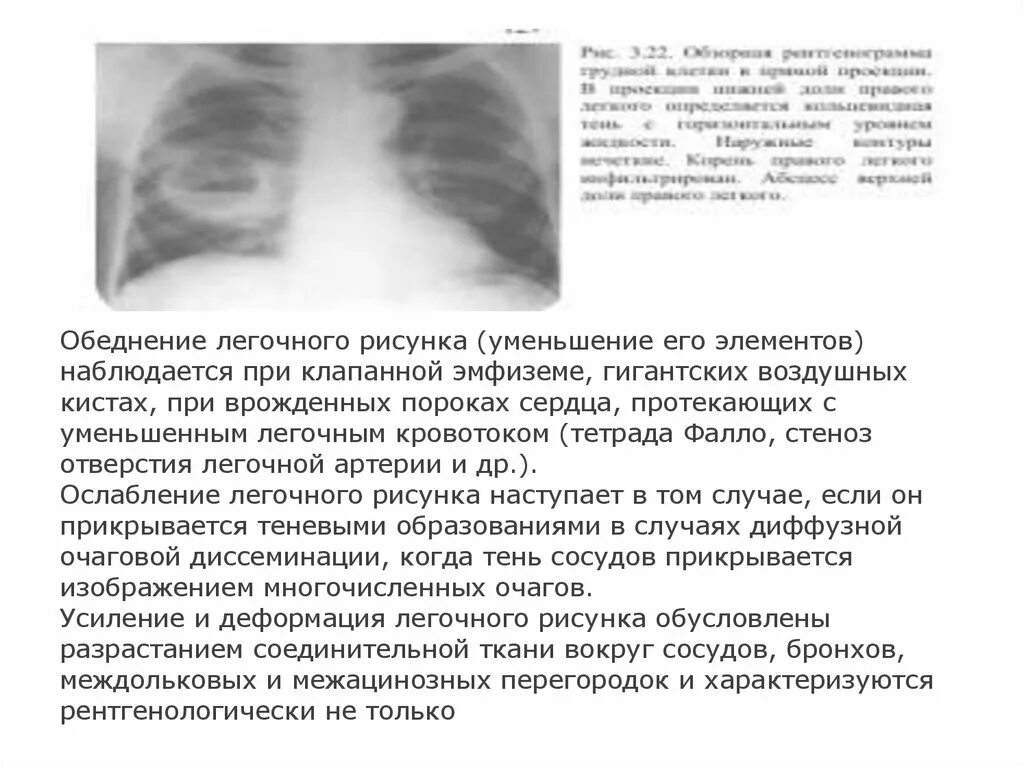 Легочный рисунок. Анализ легочного рисунка. Ячеистая деформация легочного рисунка. Легочный рисунок ячеисто деформирован. Обеднение легочного рисунка.