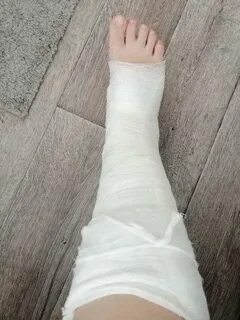 Нога ребенка в гипсе