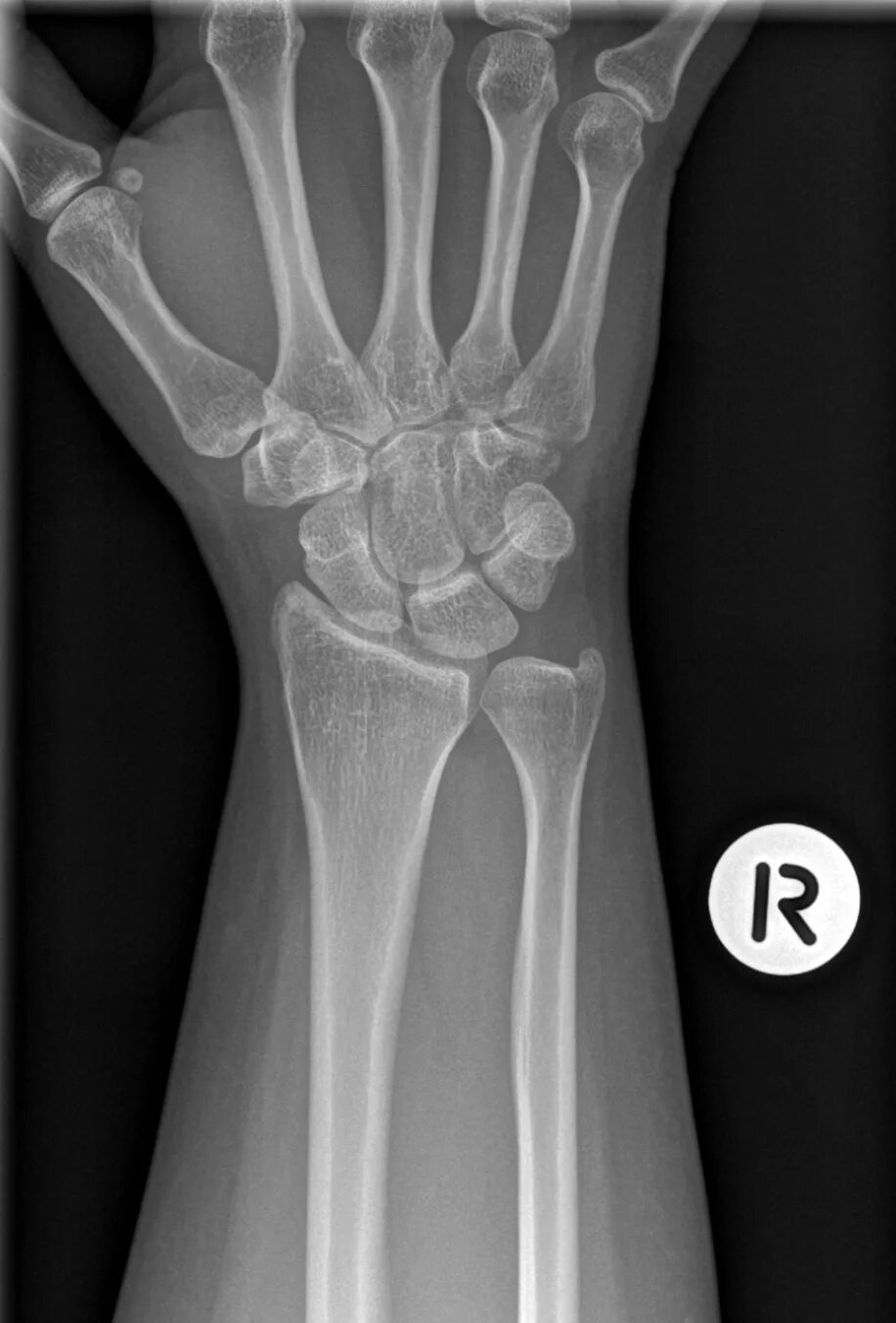 Normal hand XRAY. Xray extension