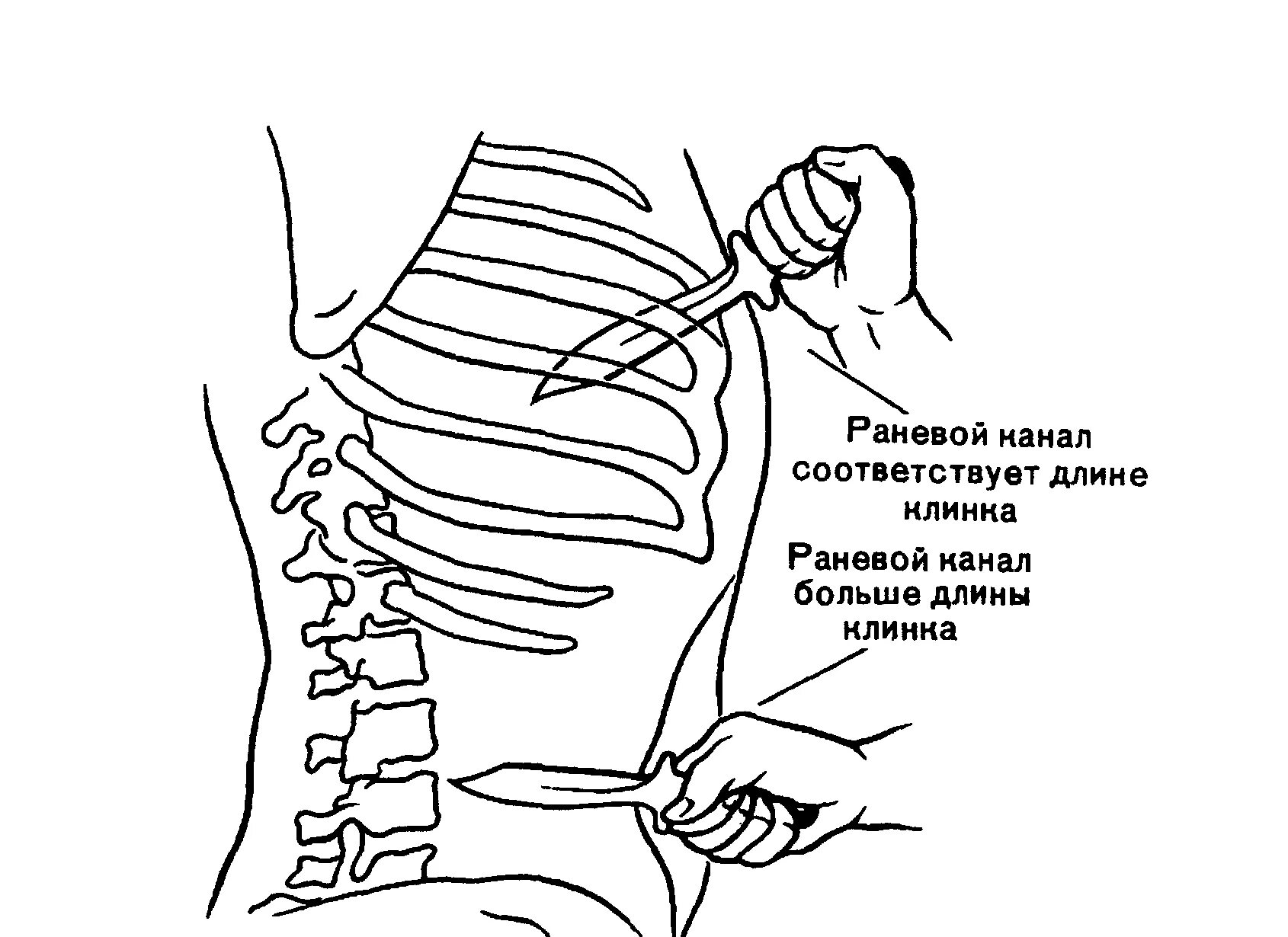 Колото резаная рана рана судебная медицина. Проникающая рана грудной клетки. Проникающее колото-резаное ранение грудной клетки. Колото резанные повреждения судебная медицина.