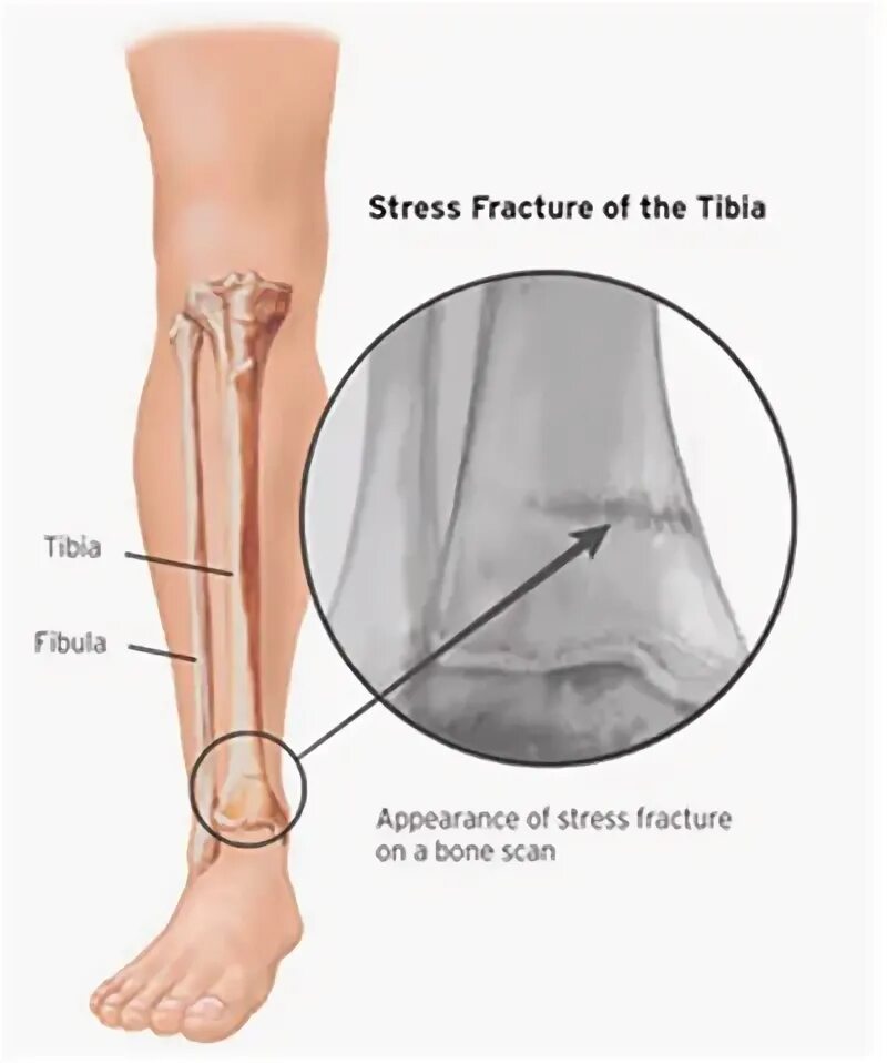Болит большая берцовая. Стрессовый перелом большеберцовой кости. Ломота в большой берцовой кости.