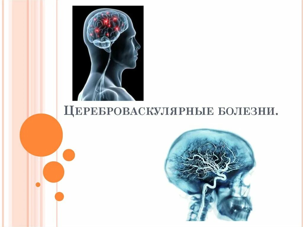 Цереброваскулярный инсульт. Цереброваскулярные заболевания. Цереброваскулярные болезни (ЦВБ). Цереброваскулярные заболевания презентация. Хронические формы цереброваскулярной болезни.