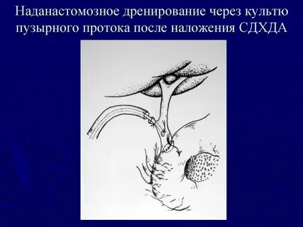 Удаление дренажа