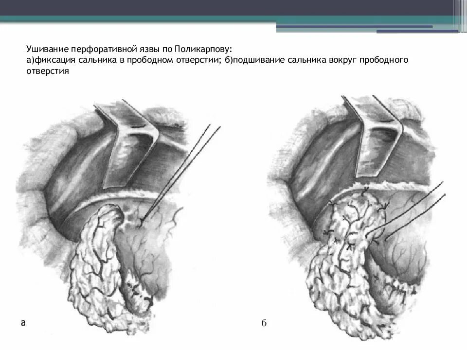 Хирургическое лечение язвы. Перфоративной язвы по Поликарпову. Ушивание язвы по Поликарпову. Ушивание перфоративной язвы. Лапаротомия ушивание перфоративной язвы.