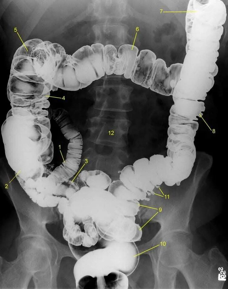 Ирригоскопия Толстого кишечника рентген. Рентген толстой кишки ирригография. Контрастирование Толстого кишечника рентген. Рентген кишечника с барием. Расширение петель кишечника