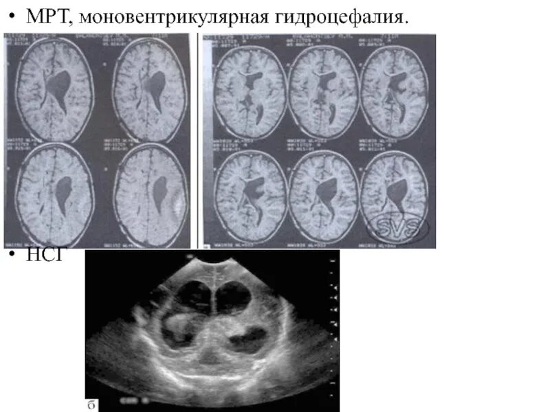 Последствия гидроцефалии головного мозга. Тетравентрикулярная гидроцефалия мрт. Наружная гидроцефалия головного мозга кт. Гидроцефалия УЗИ головного мозга. Гидроцефалия головного мозга на кт.