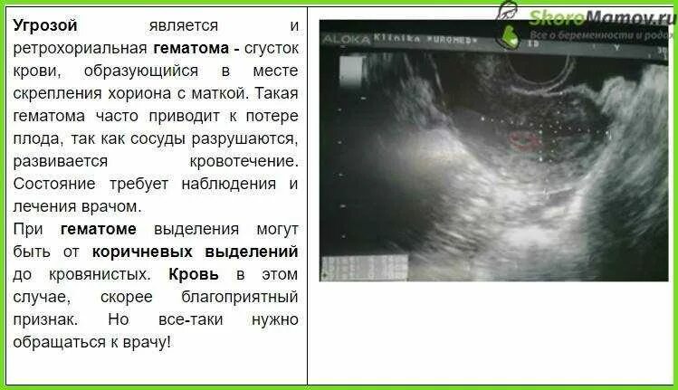 Неразвивающаяся беременность код. Признаки ретрохориальной гематомы при беременности 6-7 недель. УЗИ беременности на ранних сроках.