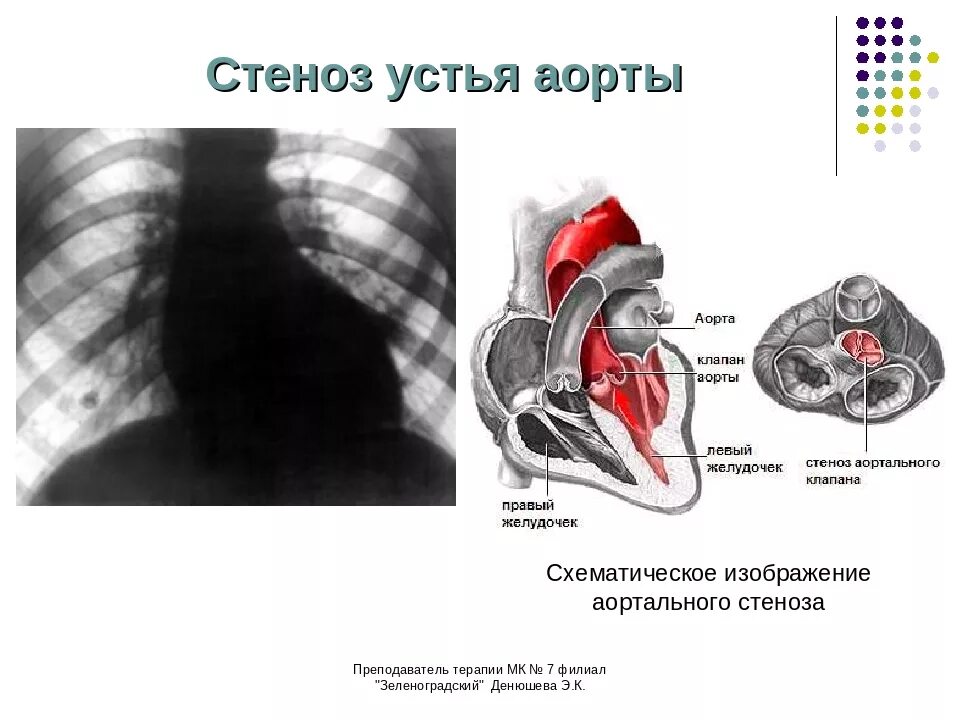 Аортальный стеноз что это такое. Врожденный стеноз аортального клапана клапан. Стеноз аортального клапана клиника. Стеноз аортального клапана клиническая картина. Стеноз аортального клапана 2 степени.