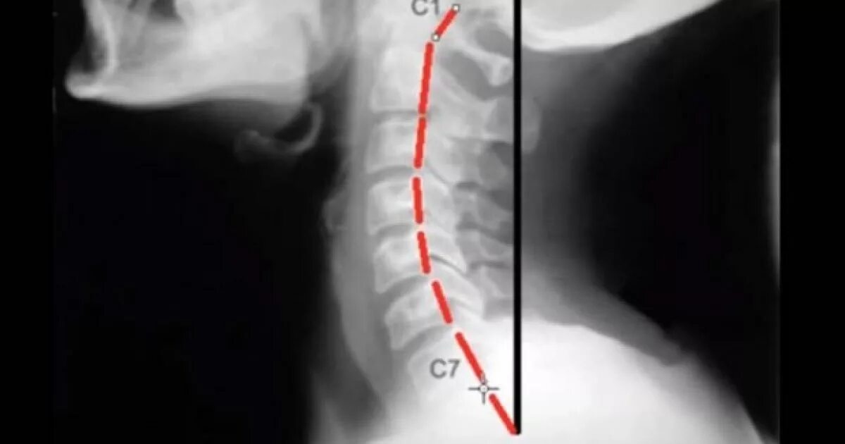 Сросшиеся отделы позвоночника. Сросшиеся позвонки рентген. Сросшиеся шейные позвонки. Срастание позвонков рентген.