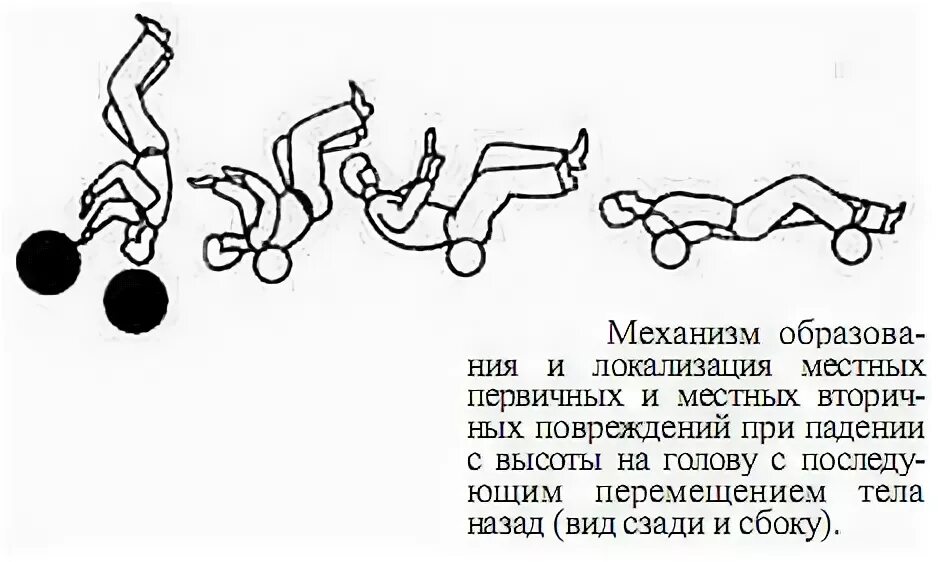 С высоты упал на ноги. Повреждения при падении с высоты. Падение с высоты на голову судебная медицина. Схема падения с высоты. Фазы падения с высоты судебная медицина.