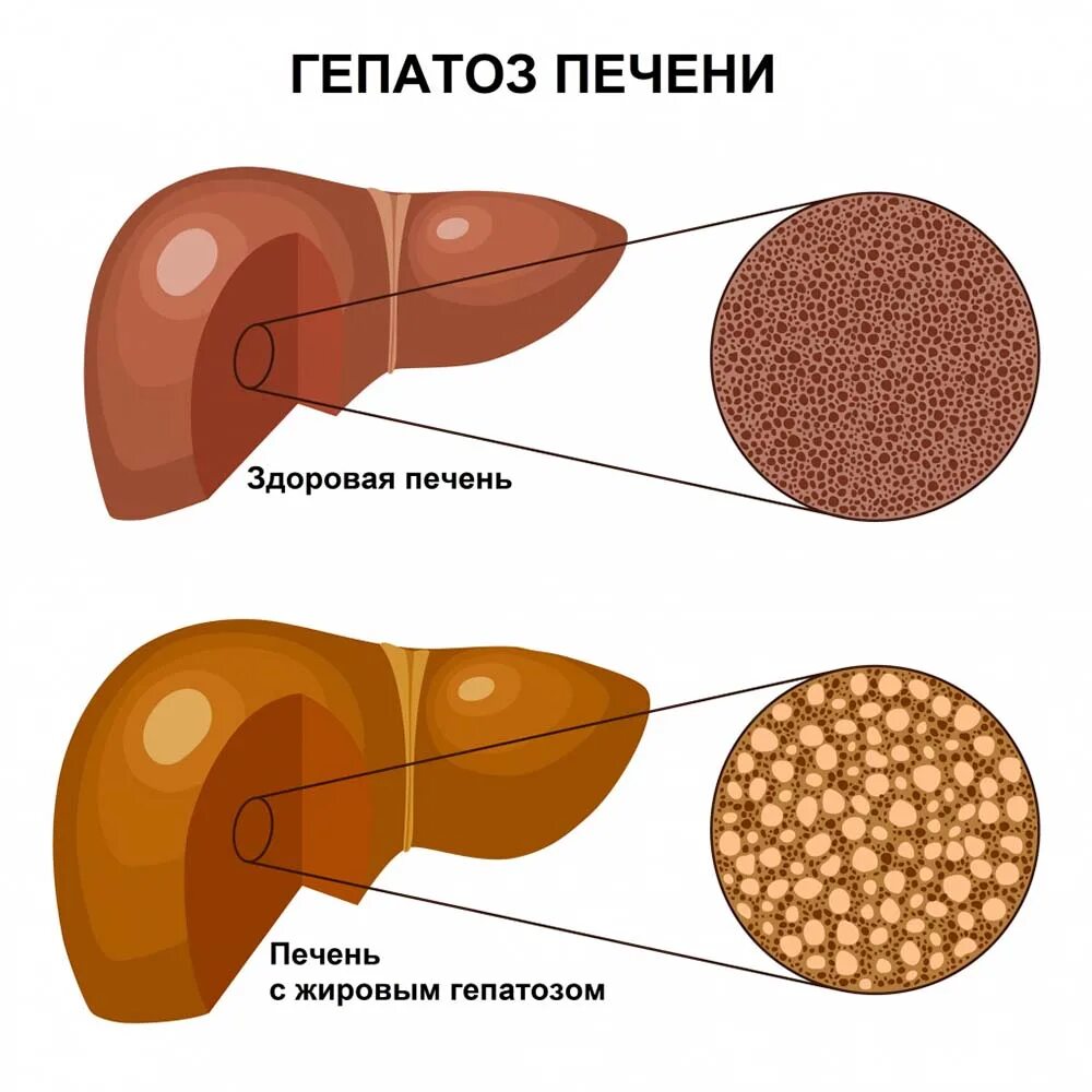 Жировая дистрофия печени (стеатоз печени). Жировая дегенерация печени гепатоз. Jirovoi gitapoz pecheni. Болезнь печени жировой гепатоз.