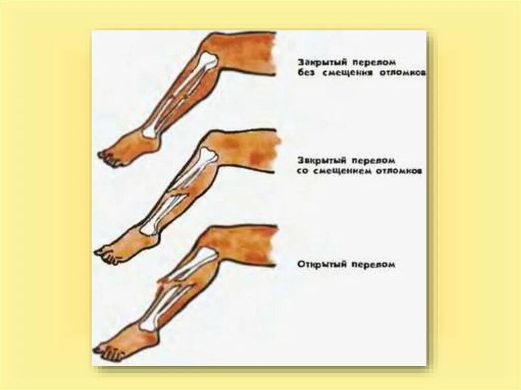 Какой вид травмы показан на рисунке. Типы переломов конечностей.. Открытый перелом без смещения. Перелом вывих растяжение.