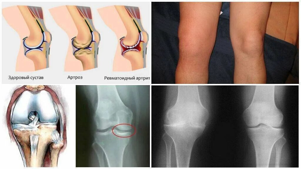 Артрит коленного сустава в домашних условиях. Ювенильный артрит коленного сустава рентген. Остеоартроз скакательного сустава. Артропатия коленных суставов. Полиартрит коленного сустава.