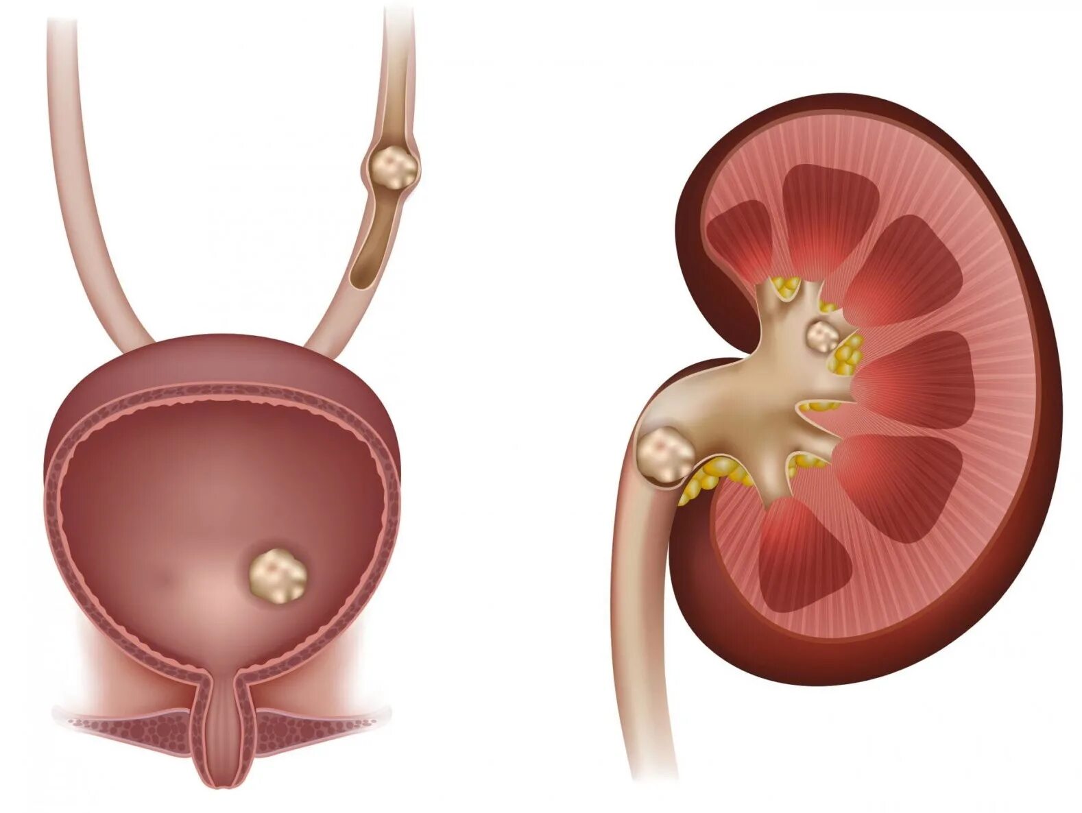 Мочекаменная болезнь камни в почках. Мочекаменная болезнь в мочевом пузыре. Мочекаменная болезнь. Обструкция мочеточника. Мочекаменная и Почечнокаменная болезнь.