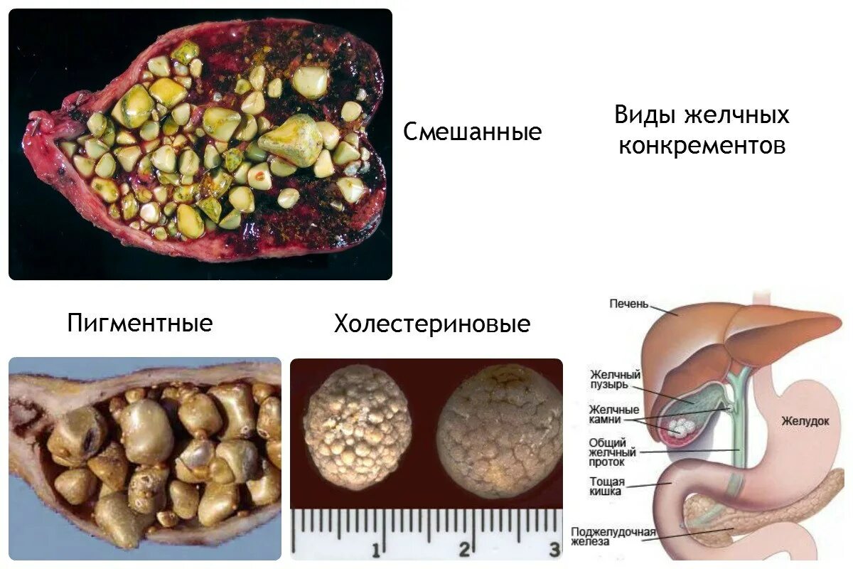 Наличие толстой мышечной стенки и мелких камней