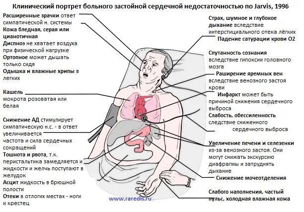 Застойная сердечная недостаточность смерть. Застойная сердечная недостаточность симптомы. Симптомы застой скрдечной недостаточности. Острая сердечная недостаточность симптомы перед смертью.