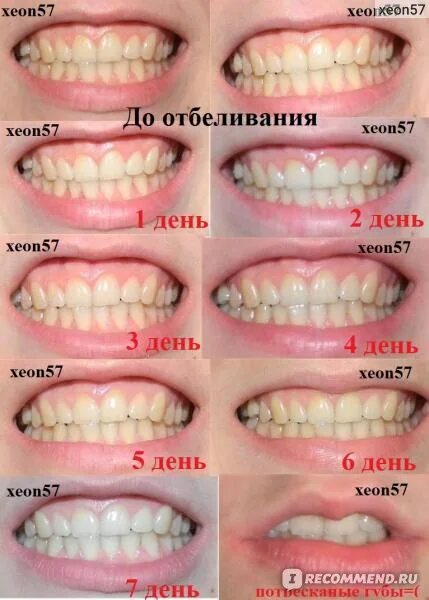 Масло чайного дерева для отбеливания зубов. Отбеливание зубов чайным деревом. Масло чайного дерева для отьеливания зуба. Отбеливание зубов маслами