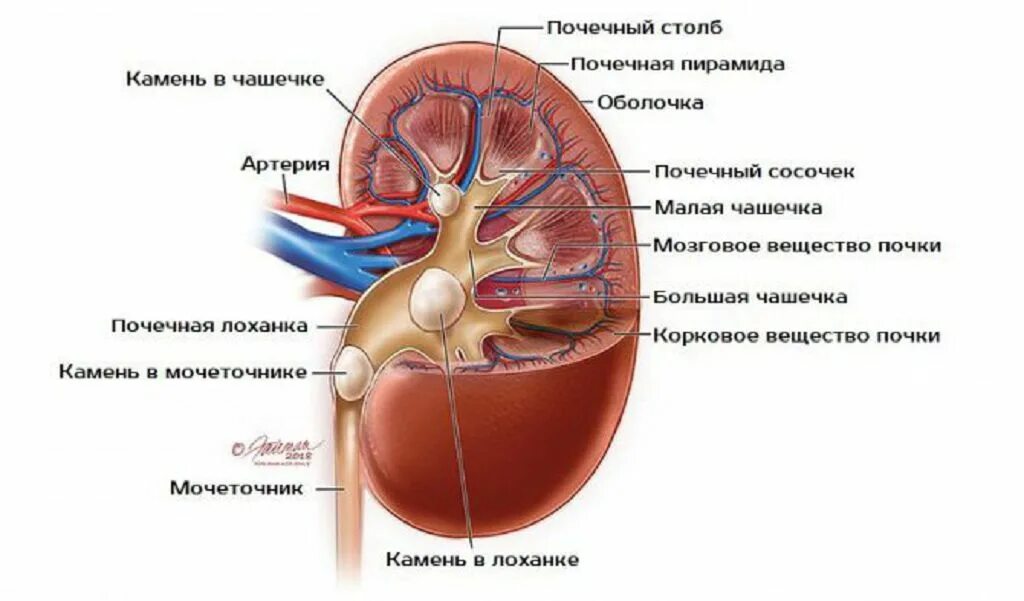 Что значит лоханка почки. Строение почки почечная лоханка. Строение почки человека с камнями. Строение почки камни в лоханке. Камень в почечной лоханке.