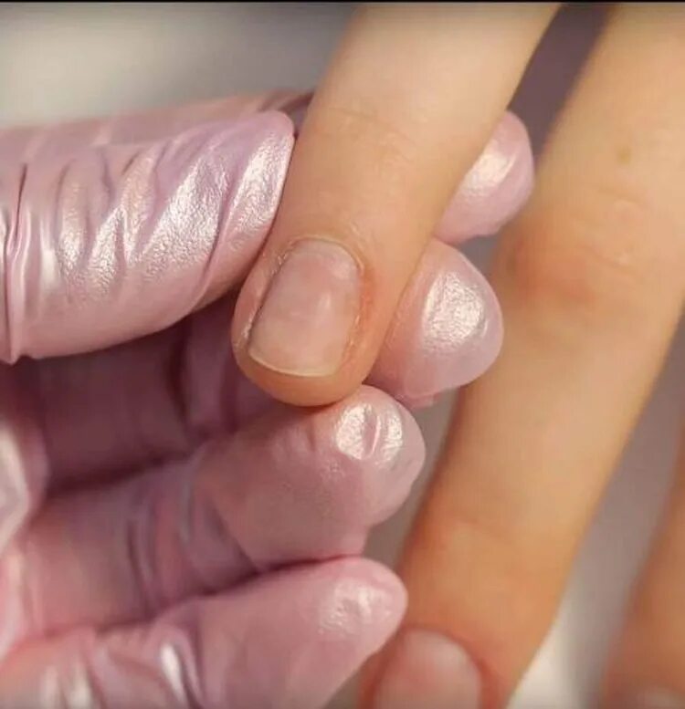 пропил ногтевой пластины. поперечные борозды на ногтях. ногти после аппаратного маникюра. пропилы лечение. пропил на ногте при аппаратном маникюре.