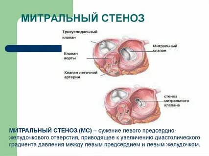 Врожденный митральный порок