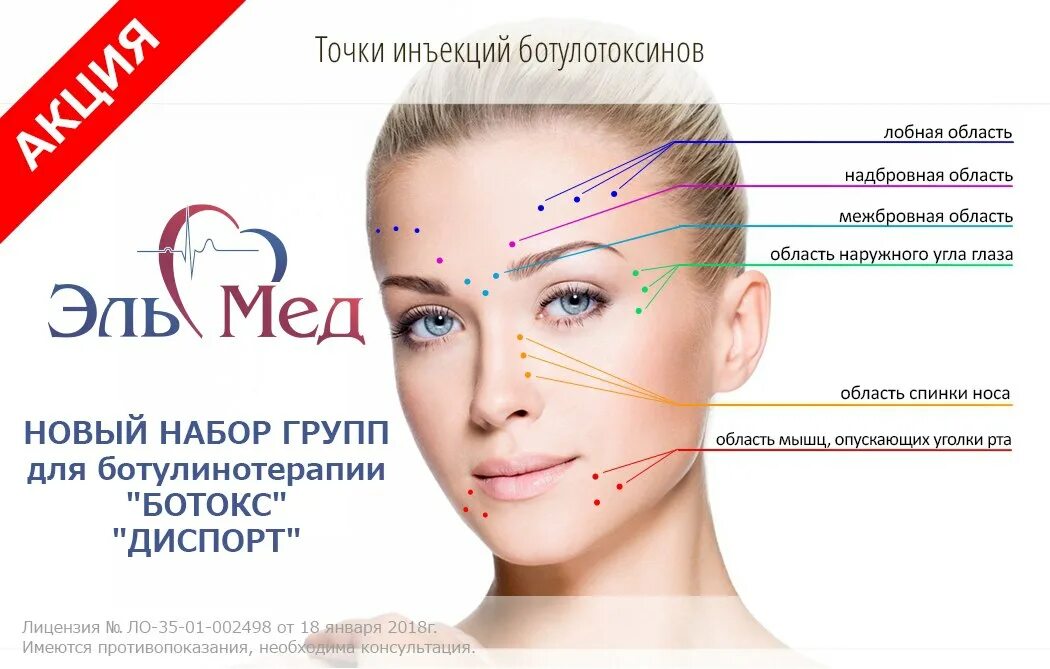 Название ботокса. Схема введения ботокса. схема уколов ботокса. точки введения ботокса схема. схема введения ботокса на лице.