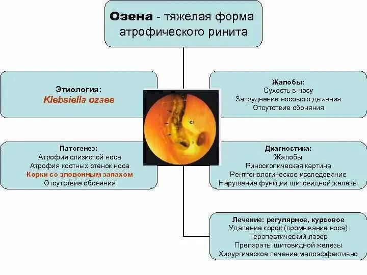 Атрофический ринит симптомы и лечение