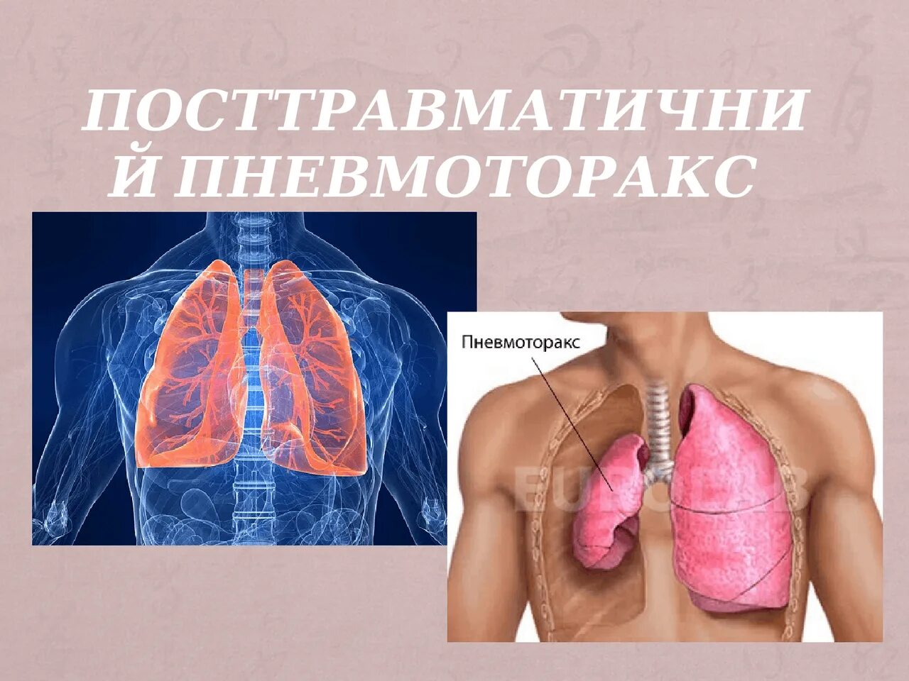 Напряженный пневмоторакс помощь. Посттравматический пневмоторакс. ПП при пневмотораксе. Открытый пневмоторакс закрытый пневмоторакс клапанный.