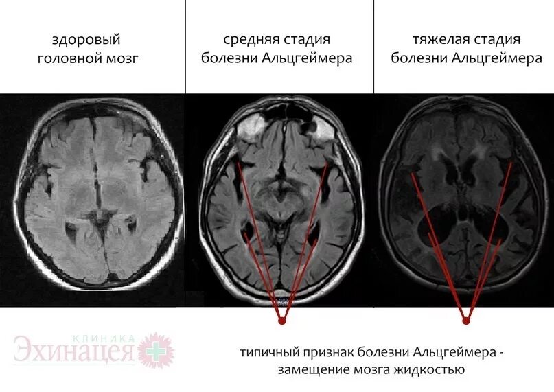 Кт и мрт при болезни Альцгеймера. Болезнь Альцгеймера снимки мрт. Мрт головного мозга болезнь Альцгеймера. Кт признаки болезни Альцгеймера.