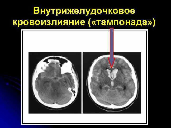 Кровоизлияние в желудочки. Тампонада желудочков мозга кт. Внутрижелудочковые кровоизлияния у новорожденных. ВЖК 4 степени у новорожденных. Внутрижелудочковые кровоизлияния гематома.