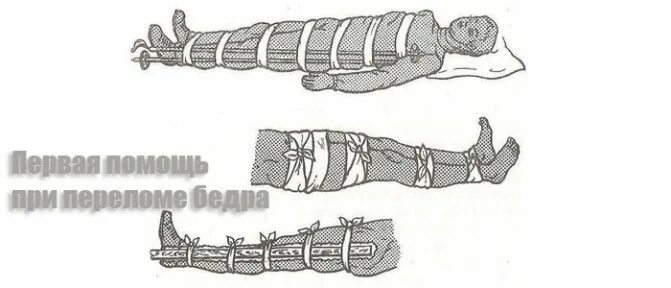 Открытый перелом бедра первая помощь. ПМП при переломе бедренной кости. Алгоритм при переломе бедренной кости. ПМП при переломе шейки бедра. ПМП при открытом переломе бедра.