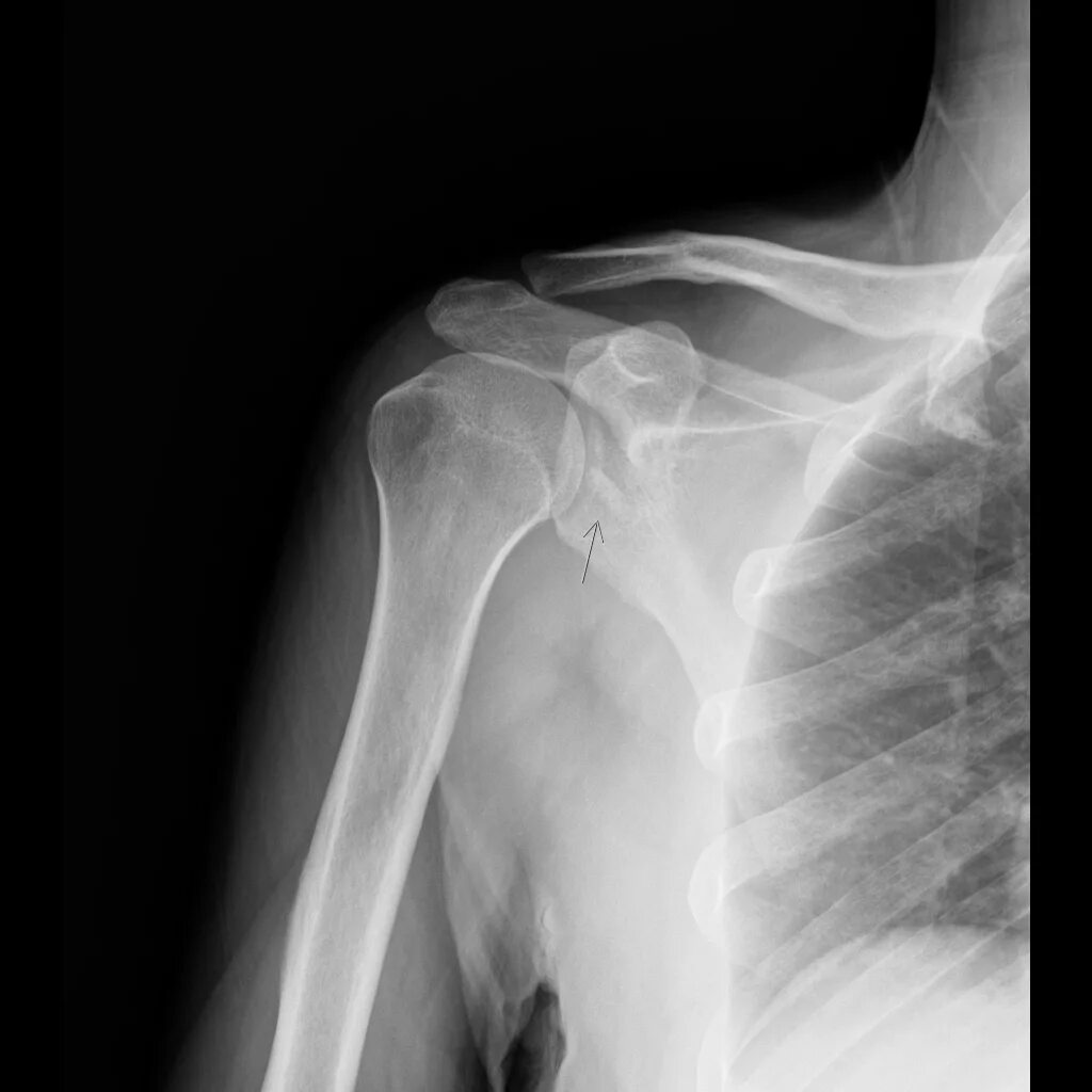 Fracture ray. Arcaea игра. Arcaea обои на рабочий. Рентген сломанного писюна. Перелом большеберцовой кости рентген.