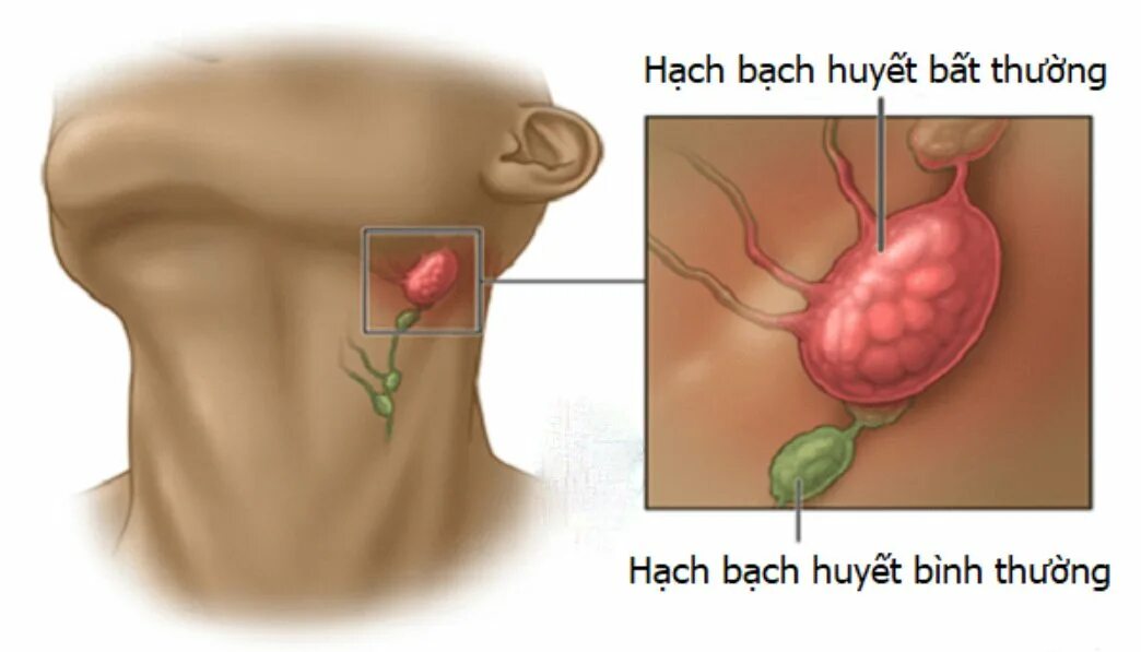 Swollen lymph nodes and glands in children Vinmec