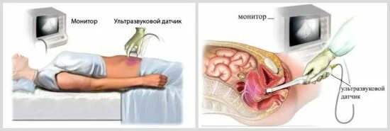Узи Малого Таза У Девственниц