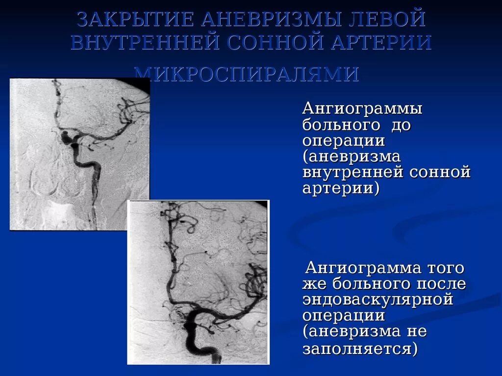 Эмболизация аневризмы микроспиралями. Аневризма сифона ВСА мрт. Фузиформное расширение аневризма. Аневризма внутренней сонной артерии кт.